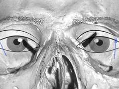 쌍수라인 올리고 싶다고 무조건 올릴수 있는거 아닙니다