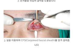 눈매교정했을때 왜 부작용이 올까? ( 비절개눈매교정과 일반매몰법의 차이 )