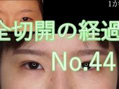 붓기빠지는 기간 1년이상이나 기다릴려고 쌍수하는 사람들은 아무도 없다