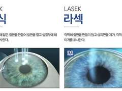 눈매교정 부작용와 라식라섹 부작용은 매우 흡사하다