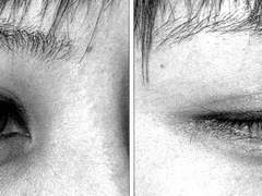 티가 나는 쌍수와 티가 나지않는 쌍수의 차이