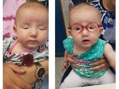 눈매교정 필요하면 해야 한다는 성형외과 의사들, 상담실장들, 그외 주변사람들이나 인터넷 글들 절대 믿지마세요