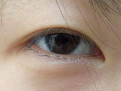 요즘은 쌍수만 해도 눈매교정 부작용이 나는 경우가 많습니다