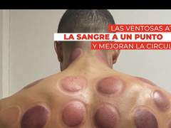 유럽 선수들의 부항요법 도입