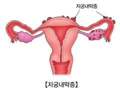 섹스만 하면 걸리는 질염에 관해