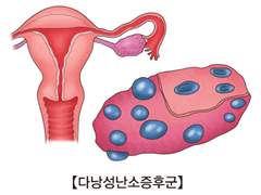 다낭성 난소 증후군이란 (feat. 내 경험)