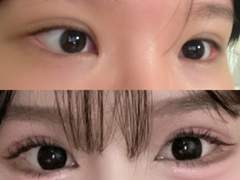 여지것 해본 시술 정리(애교 입술 팔뚝 사각턱)