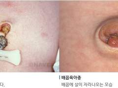 미리미리 신생아 배꼽관리