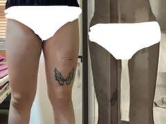 ♡하루쨩의 레전드 지방흡입 한달차 후기♡