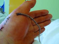 Surgical Drainage Devices Market Size, Share, Growth, Opportunity and Industry Trends 2022-2027