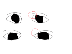 [D+105] 쌍수 후 토안의 원인
