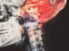 커피숍에서의 수업, 환상통에 관하여