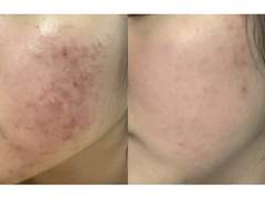 볼 여드름 찐 없애는법