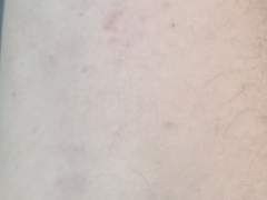 배구하다가 팔 봉쇄당했어요