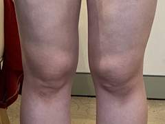 80kg ->48kg 빼도 해결 못했던 하비 다이어트 (사진)