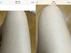 모공각화증 닭살피부 완화 간증글