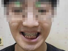 장애인한남 교정기발로차서 잇몸짼썰