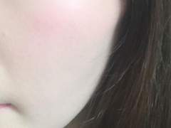 여드름 극복 아기피부 만들기