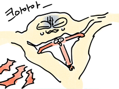 미레나 했다가 5개월만에 뺀 후기