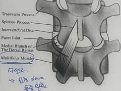 요통치료 침구강의 복습
