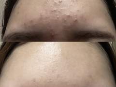 트러블 케어를 위한 피부관리법 및 제품추천