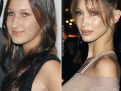 인플루언서 시술