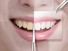 가성비 치아 미백법