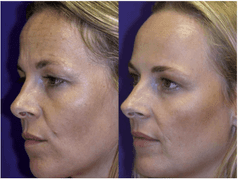 나이대별 추천하는 시술 정리 + 리프팅 시술에 관한 의견 총정리