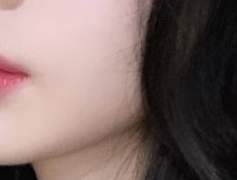 이틀만에 여드름 박멸하기