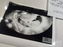 49살 아저씨랑 연애 하고 임신하고 낙태 수술한썰