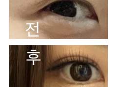 쌍커풀 수술 후기 및 병원 정보 초성 [+본인 전후 사진 포함]