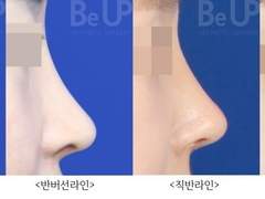 코성형 성형외과 발품 팔아본 후기 (병원 4곳) | 트임+코성형 상담